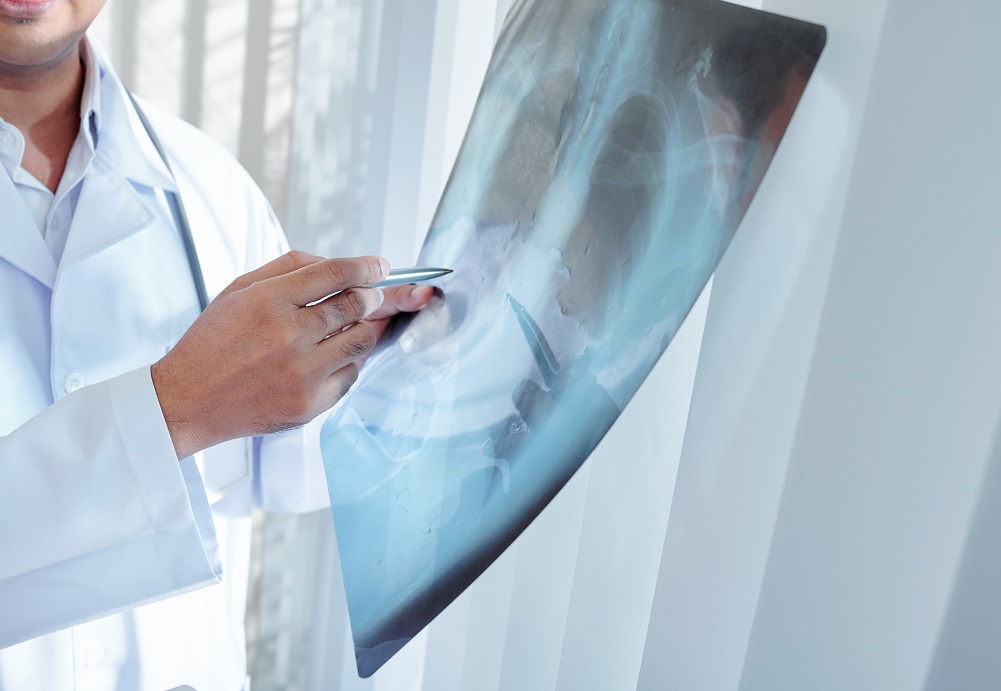 Le dépistage organisé du cancer du poumon se profile