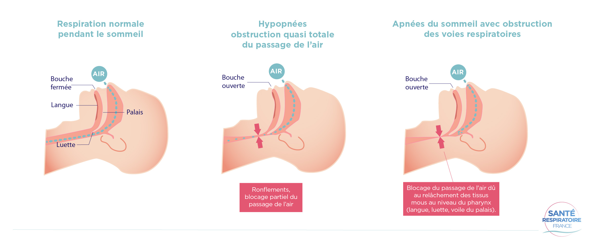 Les apnées du sommeil